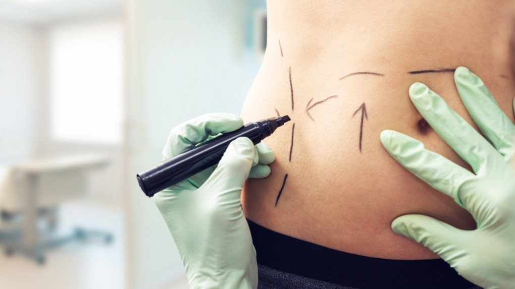Liposukcja - wszystko, o co chcielibyście zapytać lekarza