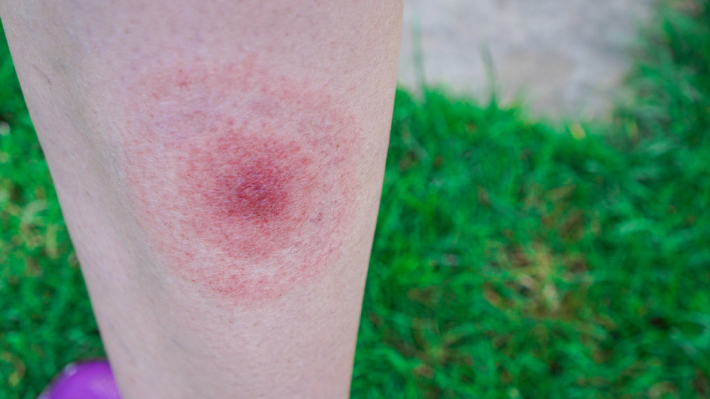 Borelioza nietypowe objawy