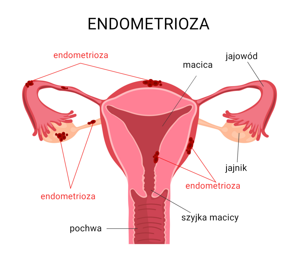 Endometrioza - objawy, leczenie, dieta