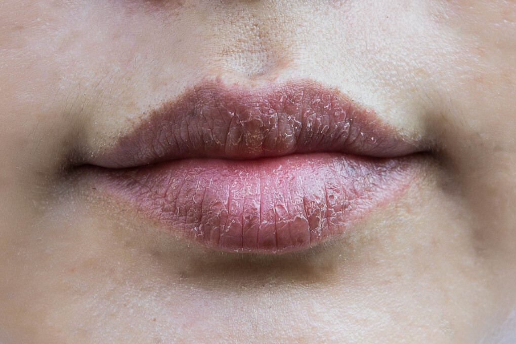 Spierzchnięte usta - przyczyny, hormony, domowe sposoby 