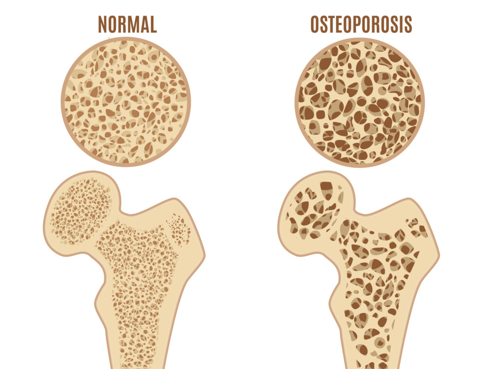 osteoporoza objawy)