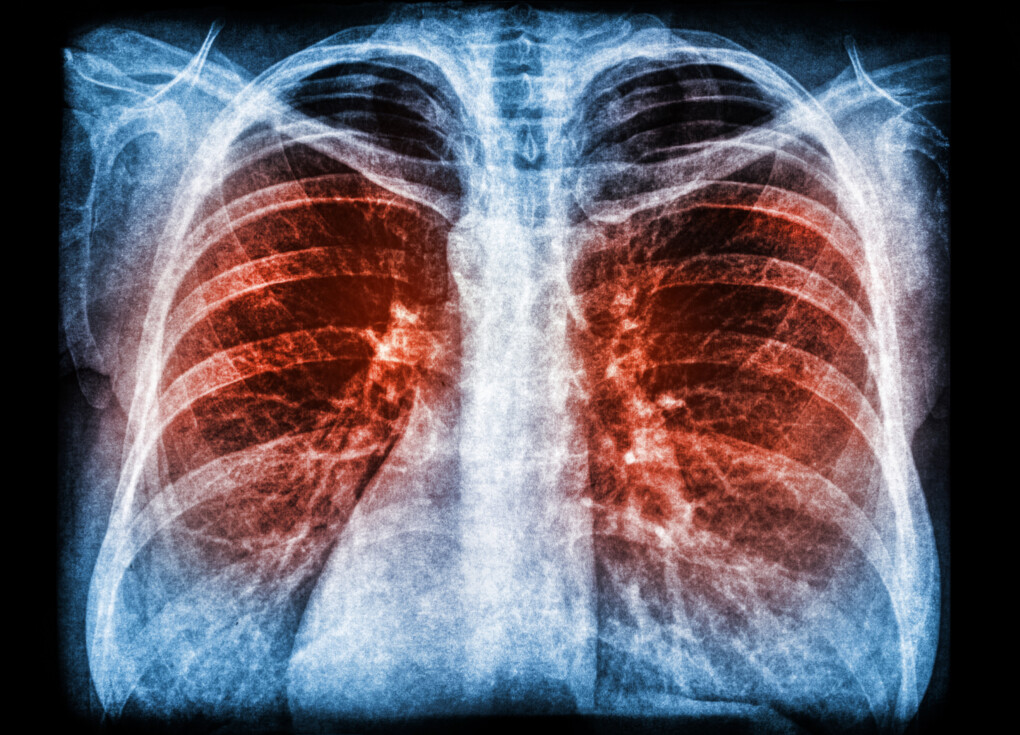 Zapalenie płuc - przyczyny, objawy, leczenie