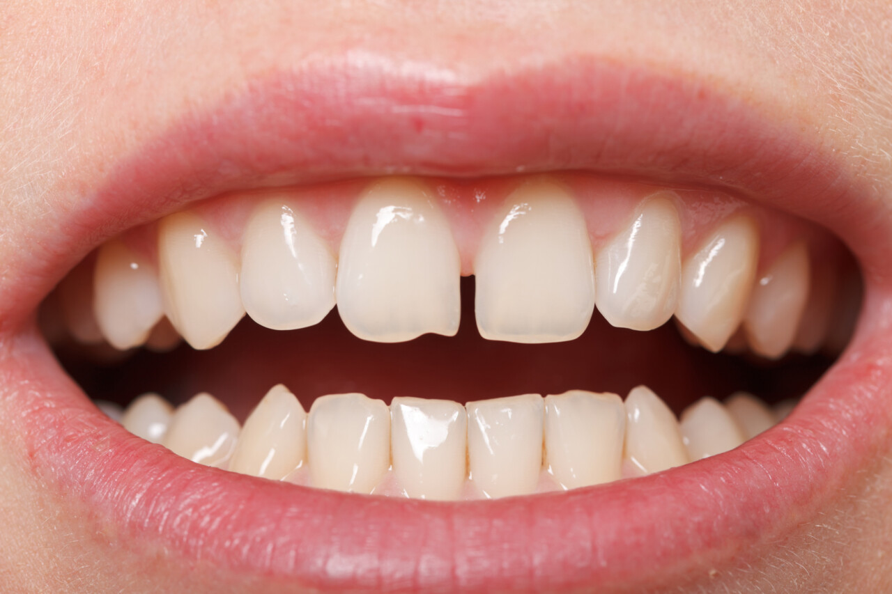 Diastema - przyczyny, rodzaje, leczenie szpary między zębami