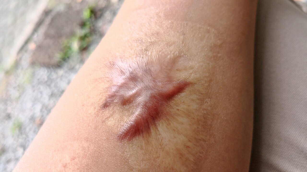 Bliznowiec (keloid)
