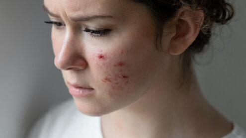 Gronkowiec na twarzy kobiety powoduje trądzik